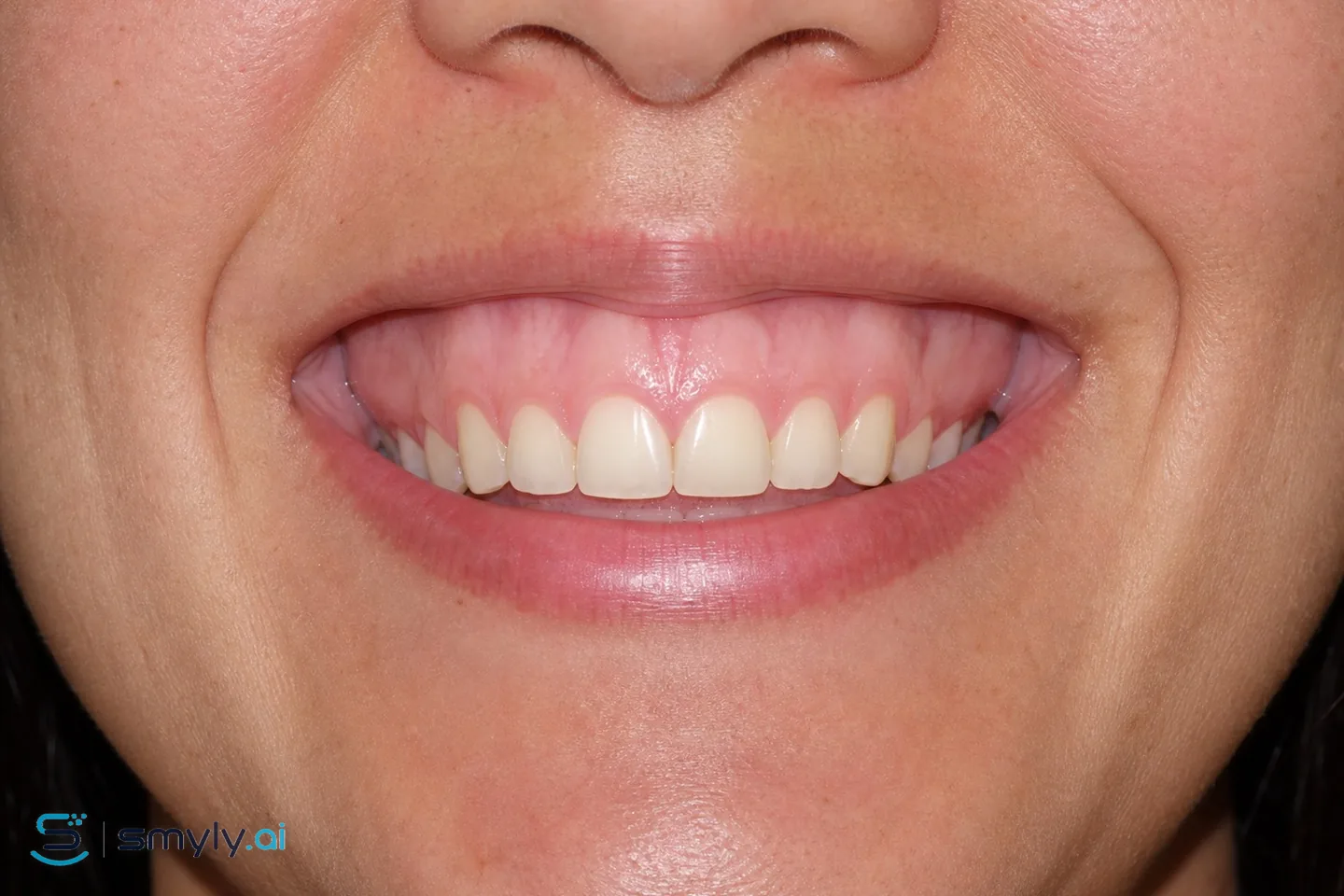 Before: sample smile before crown lengthening