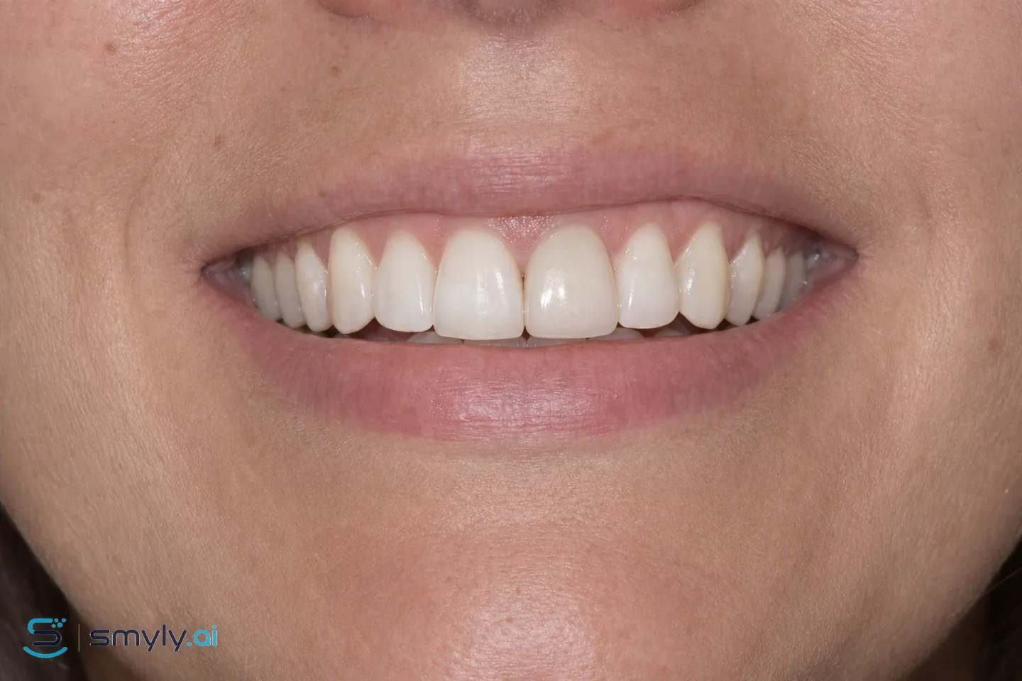After: Smyly simulation of crown replacement on the same smile