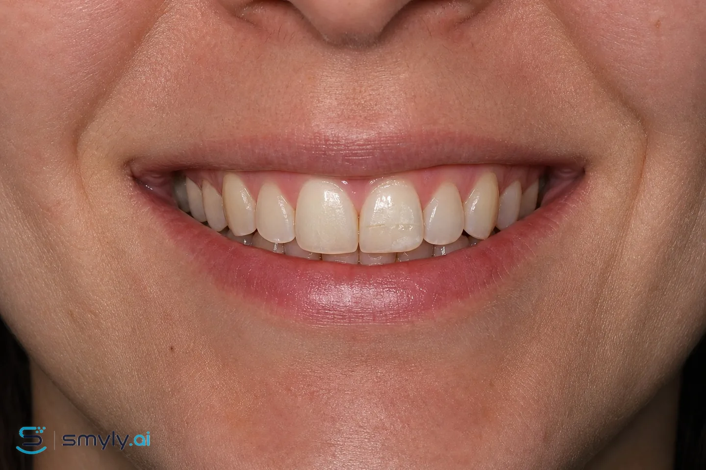 Before: sample smile before enamel defect repair
