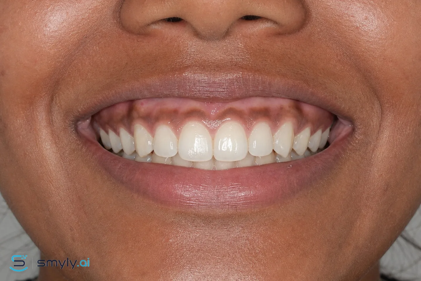 Before: sample smile before gum depigmentation