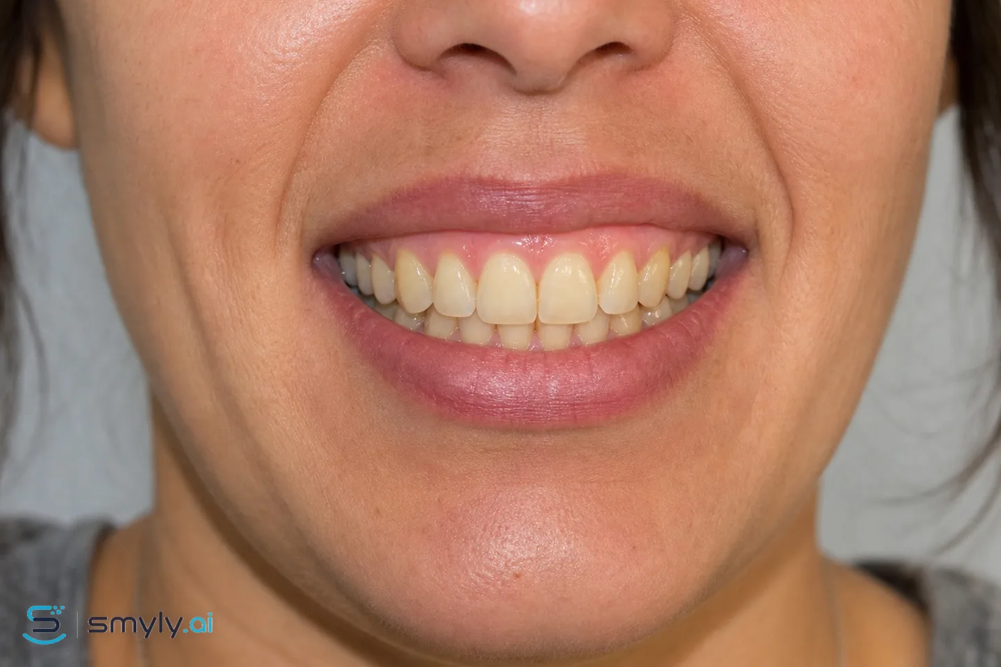 Before: sample smile before teeth whitening